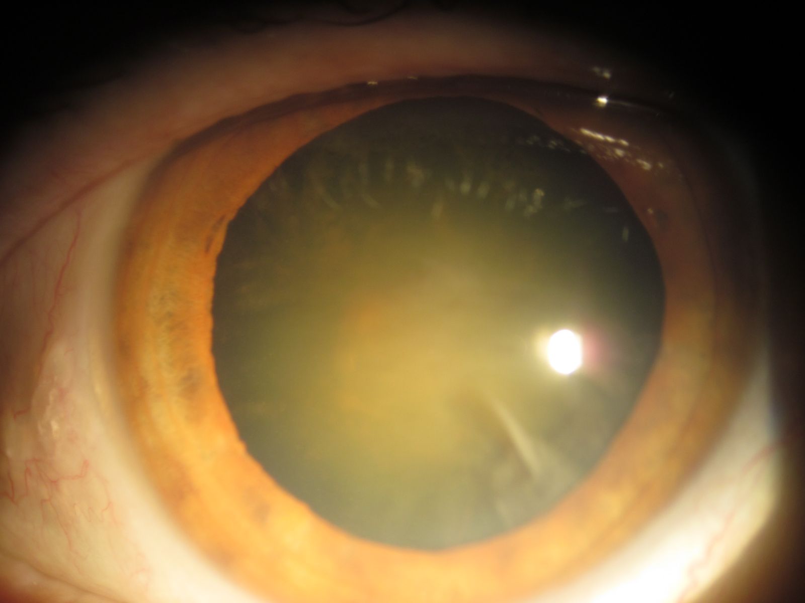 Катаракта глаза лучшие хрусталики. Тетаническая катаракта. Переднекапсулярная катаракта. Спицевидная катаракта. Диабетическая катаракта биомикроскопия.